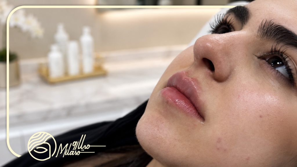 نمونه تزریق فیلر لب در کلینیک میلارو