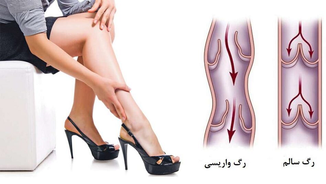 لیزر واریس پا
