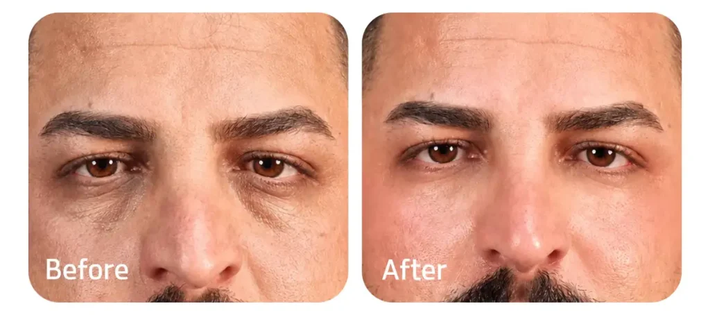 نمونه کار فیلر مردانه