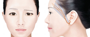 انواع لیفت شقیقه با نخ