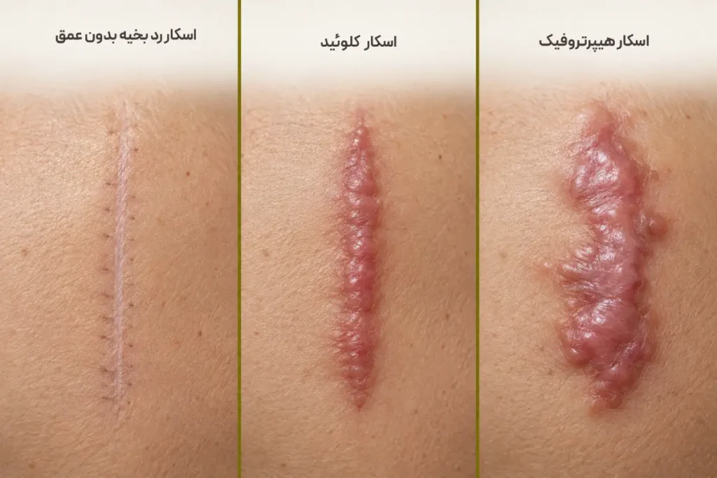 تفاوت اسکار هیپروتروفیک و بخیه ساده 