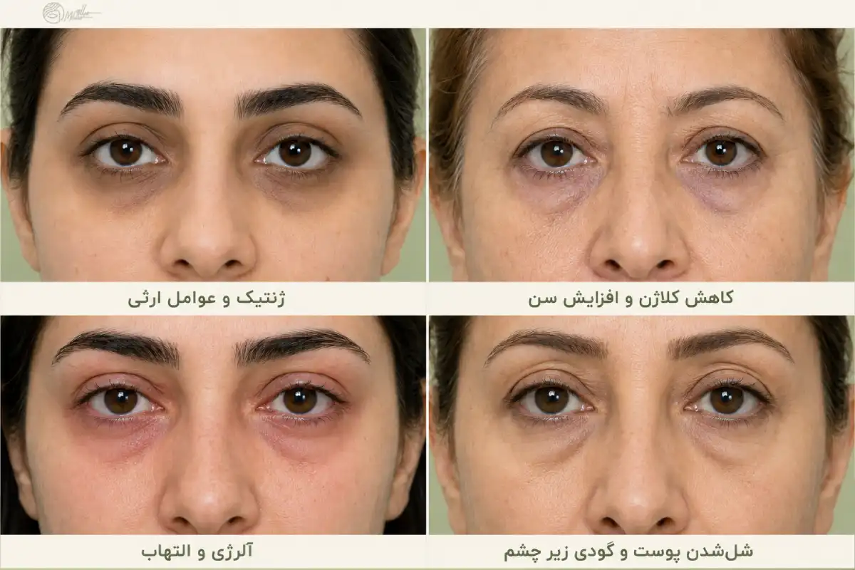 مقایسه انواع تیرگی چشم که به دلایل مختلف ایجاد شده اند. 