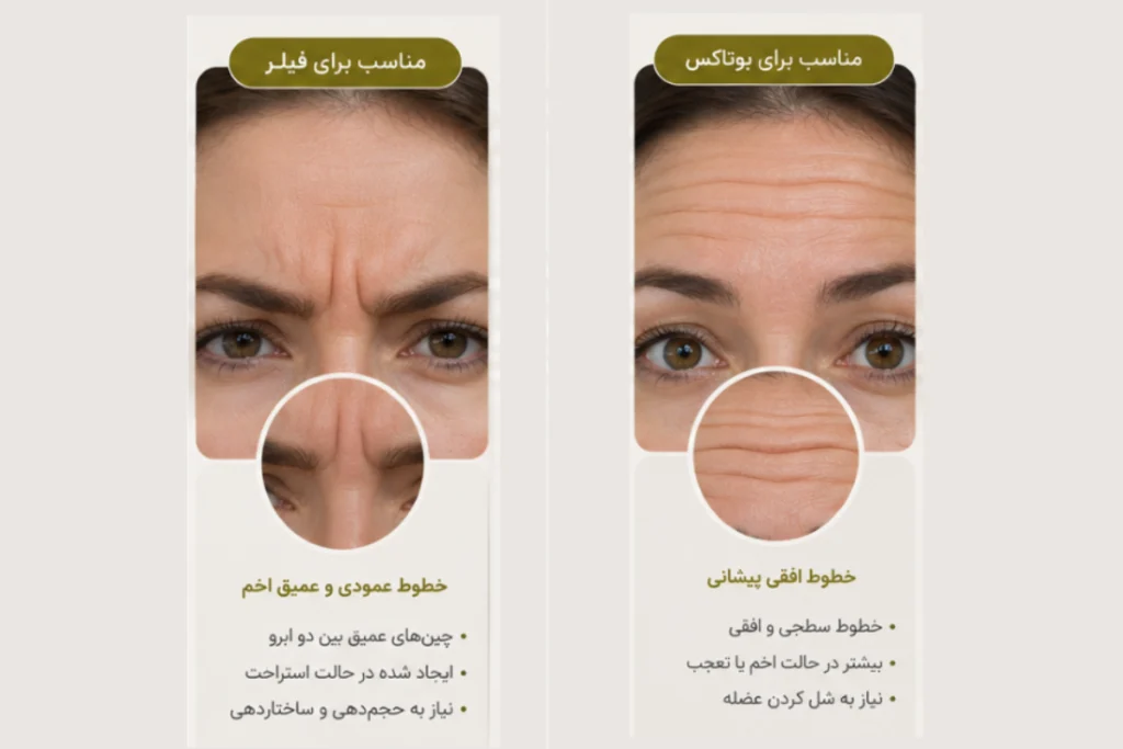 فیلر خط اخم و بوتاکس خط اخم
