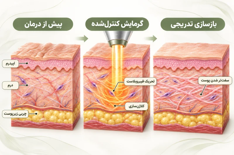 مکانیزم اثر لیزر جوانساز